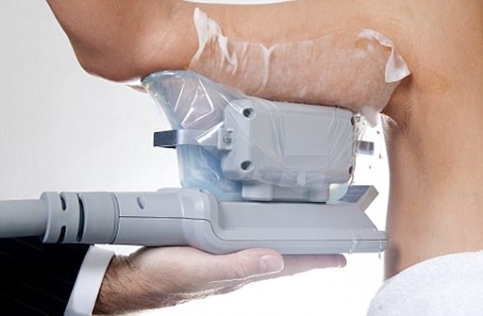 fat freezing arms South Shields