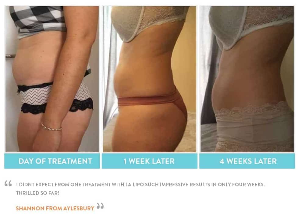 before, Cryolipolysis South Shields