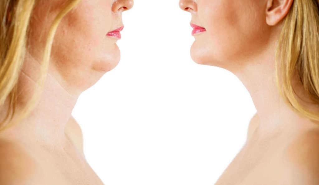 Double Chin treatment South Shields before and after results