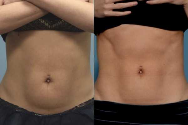 body sculpting FAQs South Shields