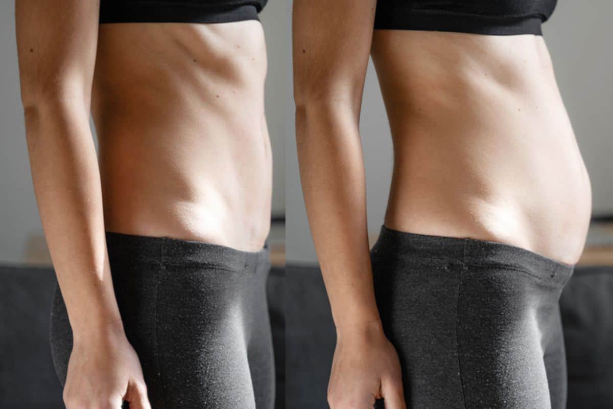 How long does diastasis recti take to improve South Shields?