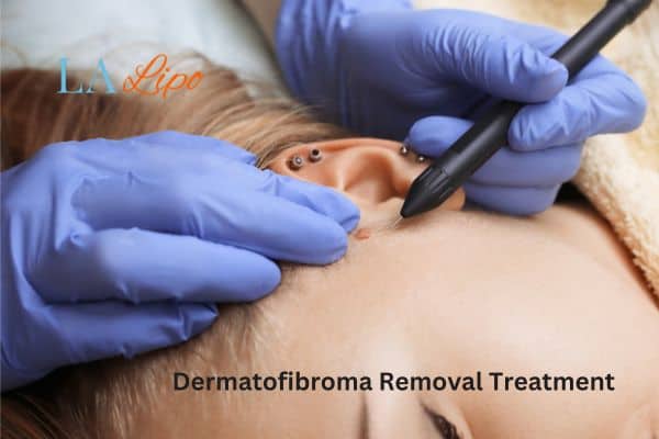 Dermatofibroma Removal Treatment South Shields