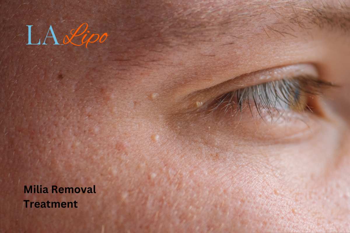 Cryopen Milia Removal: Is It the Easiest and Safest Option South Shields?