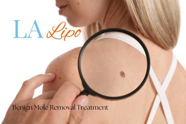 Woman having her inspection of blemish before mole removal South Shields