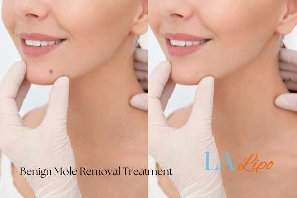 woman's before and after mole removal South Shields results