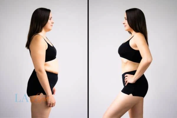 image of woman before and after results of LA-EMS Body Sculpting South Shields to help treat Diastasis recti