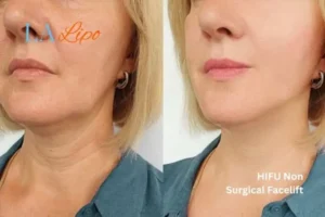hi-fu for wrinkles South Shields before and after results