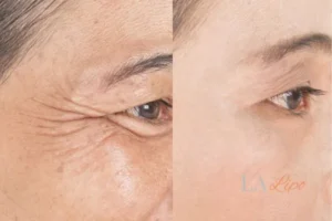 Before and after results of woman - HI-fu wrinkles reduction treatment South Shields