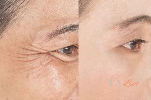 Before and after results of woman - HI-fu wrinkles reduction treatment South Shields