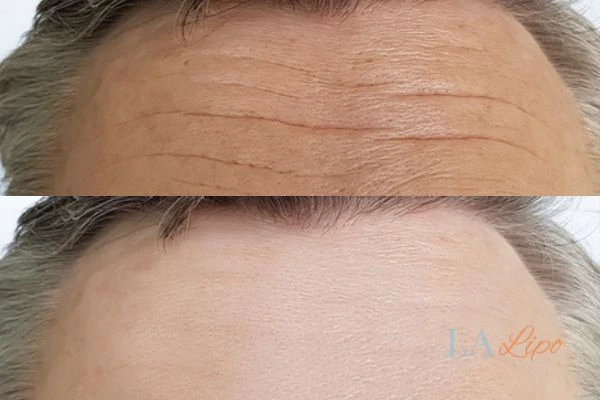 results of HIFU South Shields on mans forehead to help reduce lines and wrinkles