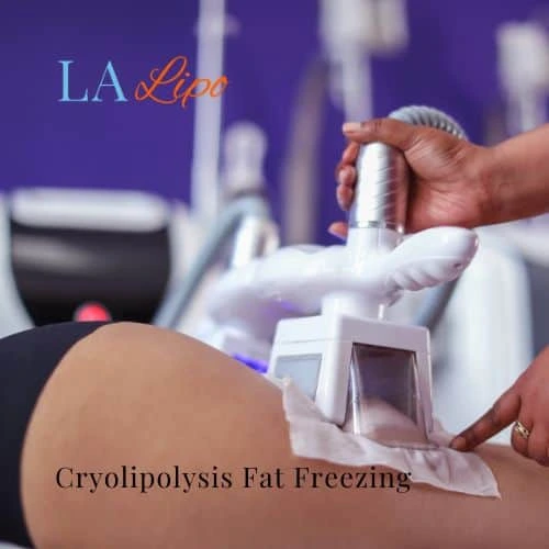 fat freezing - Cryolipolysis South Shields