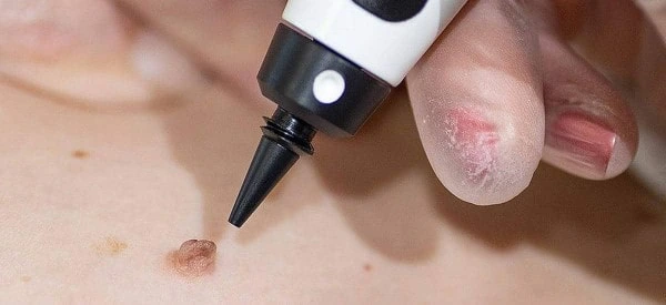 skin tag removal using cryopen South Shields