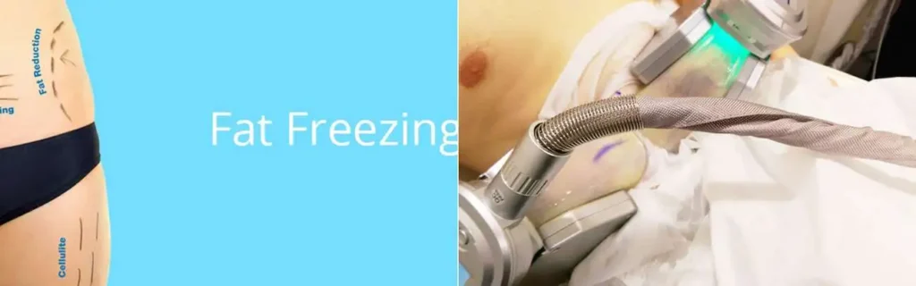 Fat freezing South Shields on multiple areas of the body
