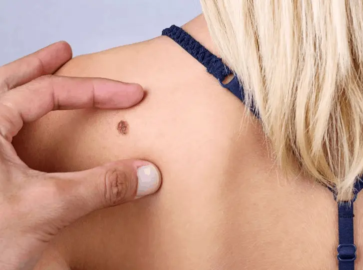 woman having mole removal South Shields consultation before treatment.