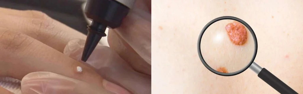 Person getting moles removed with cryopen South Shields