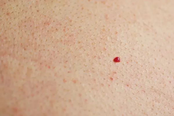 close up of a cherry angioma South Shields