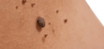 image of a skin tag South Shields
