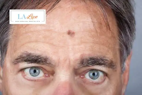 Solar Lentigo Removal South Shields image of man with mark on his forehead