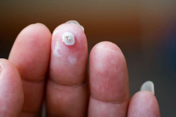 wart on person finger - cryotherapy to treat from LA LIPO South Shields