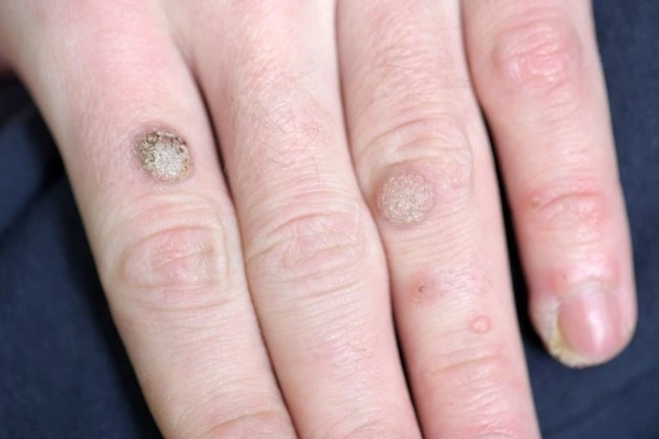 photo of warts on person hand - see wart removal South Shields from LA LIPO