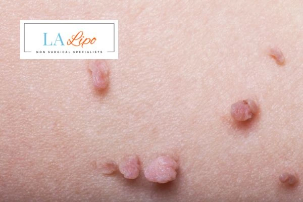 Does cryopen skin tag removal South Shields hurt? Find out now call our team today!