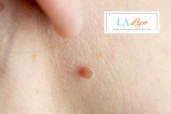 Book skin tag removal South Shields today speak to our team now!