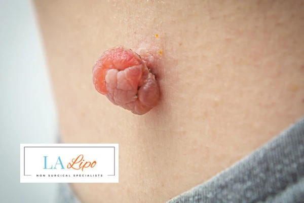Interested in skin tag removal South Shields? Concerned about the pain? Find out more today!