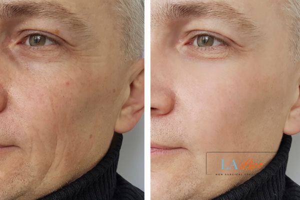 See the amazing results of Morpheus8 Treatment South Shields!