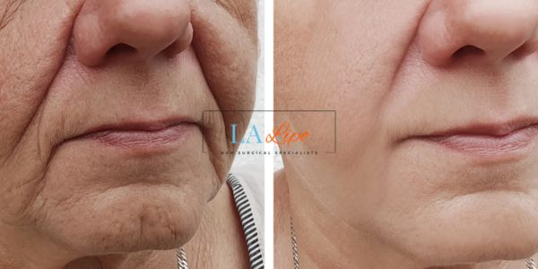 Older lady deeper wrinkle reduction - LA LIPO Morpheus 8 Results South Shields