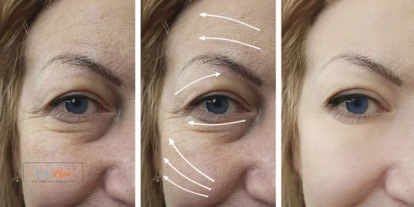 Amazing eye lift Morpheus 8 results South Shields