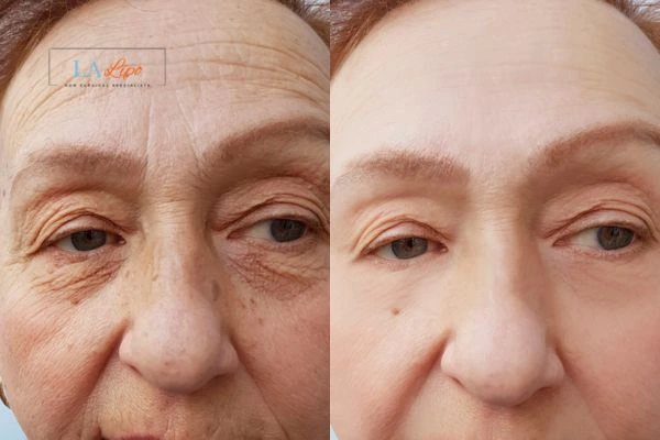 The powerful benefits of Morpheus8 Treatment South Shields - Call Our team today!