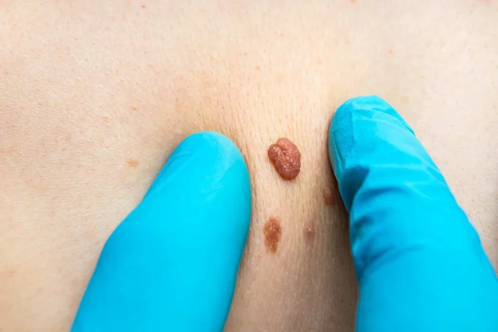 LA LIPO Cryopen Lesion Removal Prices South Shields