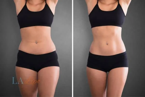 before and after results of non-surgical treatment to help a woman's body image and mental health South Shields