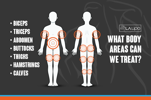 Diagram to show areas you can have LA-EMS Body Sculpting Treatment South Shields
