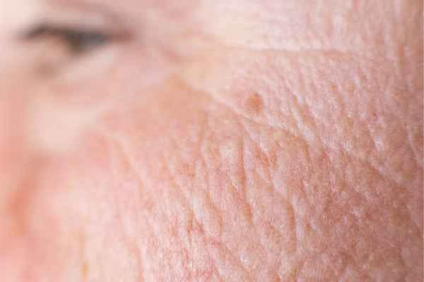 close up picture of a woman's face showing an age spot South Shields