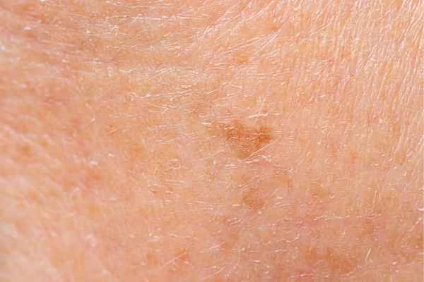 close up picture of age spots South Shields