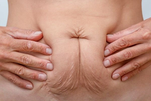 Image of a woman's stomach with loose skin - example of skin tightening South Shields options